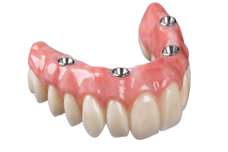 Carga imediata ou Protocolo dentário na Allegra Odontologia (1)