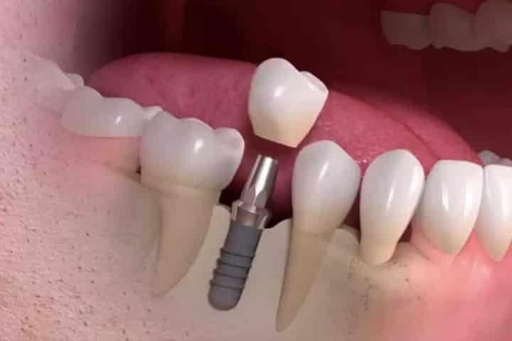 Implantes dentarios - Centro de Odontologia Ana Rosa