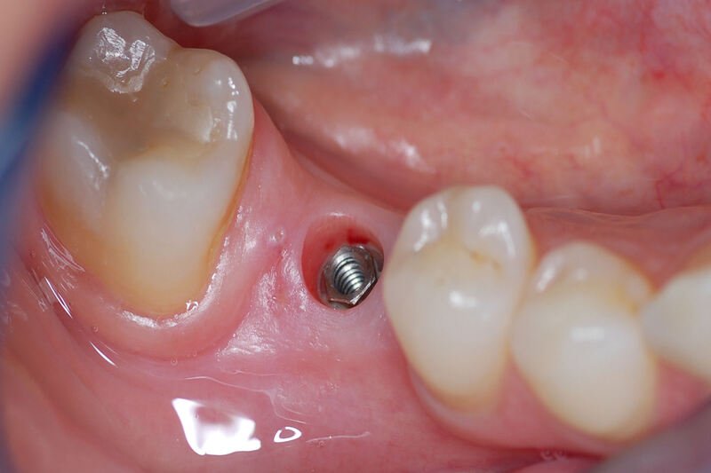 Implantes dentarios