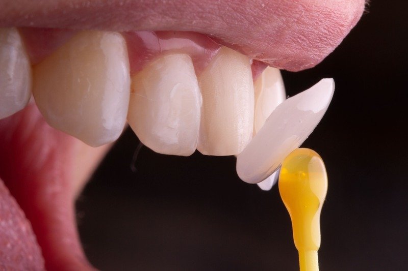 Lentes-de-porcelana-muito-finas-com-minimo-desgaste-na-Allegra-Odontologia-1