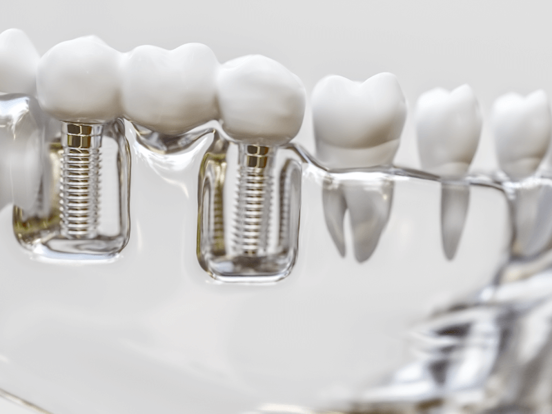 implantes dentarios no Centro de Odontologia Ana Rosa